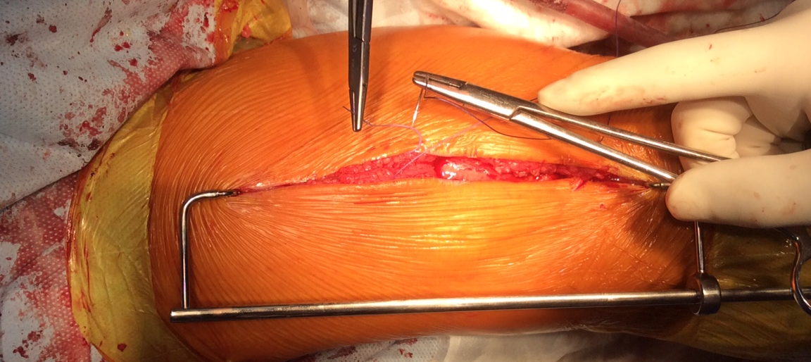 Застосування блоку вирівнювання розрізу