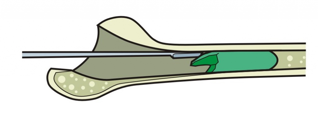 Застосування долота жолобчастого ревізійного для відшарування цементу