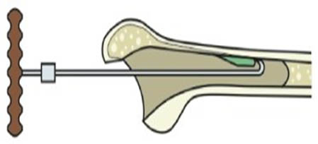 Застосування екстрактора різьбового з крючком