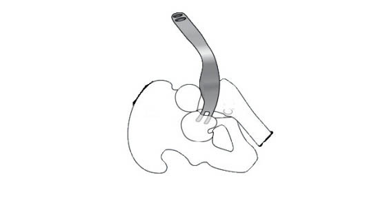 Застосування елеватора для виведення діафіза стегна в рану при протезуванні