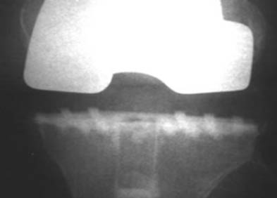 Застосування голчастого перфоратора плато Tibia