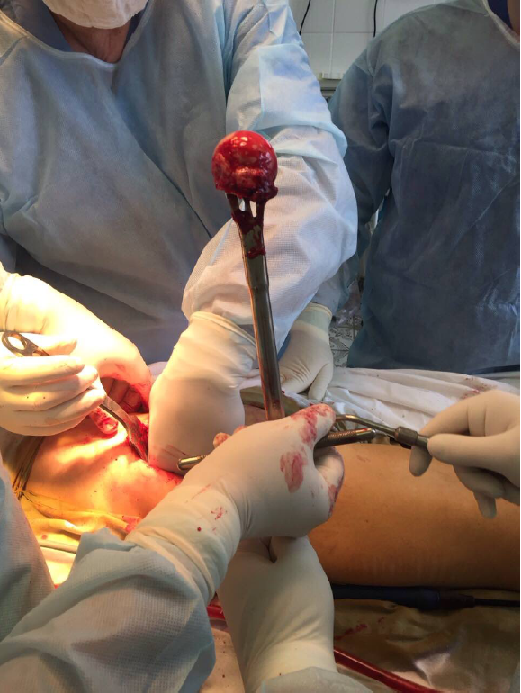 Застосування вилковий екстрактора для головки стегна