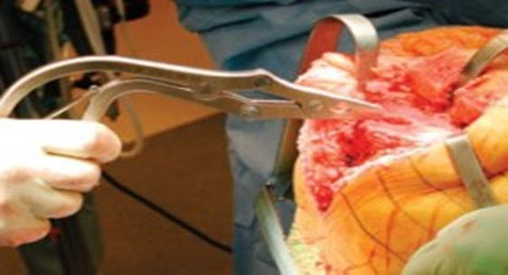 Застосування ортопедичних кусачок Люера (Luer)