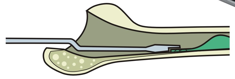 Застосування остеотома для розщеплення цементної пробки зігнутий (прапорець)