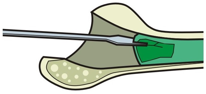 Застосування остеотома для розщеплення цементної пробки прямий (прапорець)