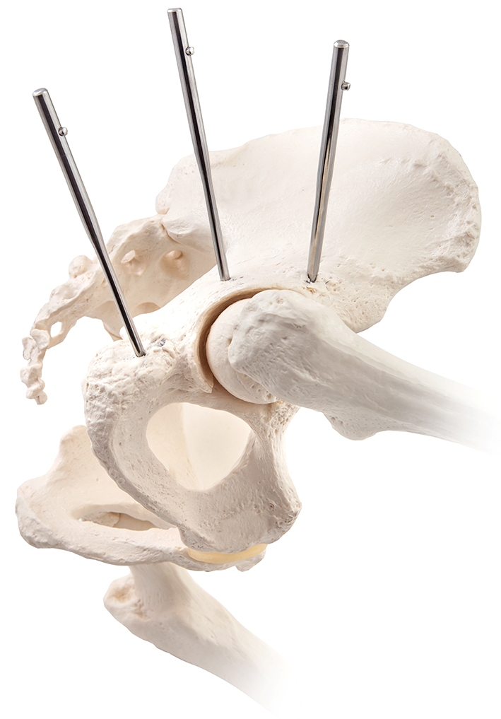 Ранорозширювачі (піни)