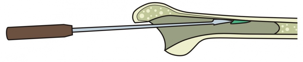 Застосування распатора для обробки кістково-мозкового каналу