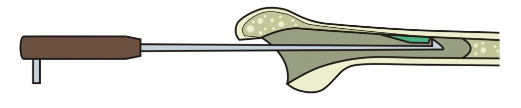 Застосування распатора зворотного ходу