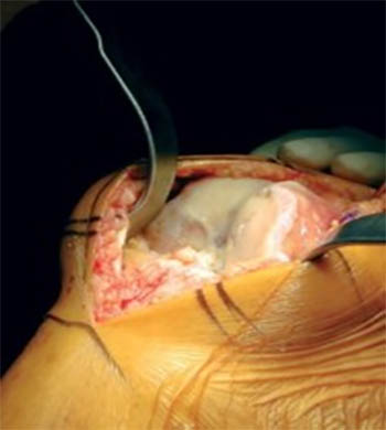 Застосування ректактора надколінника