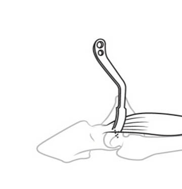 Застосування ретрактора Альві