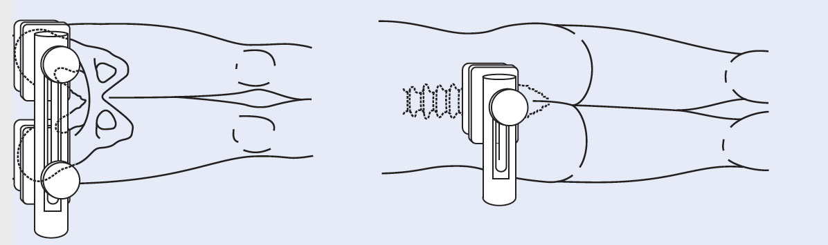 Застосування позиціонера пацієнта на столі (комплект упорів)